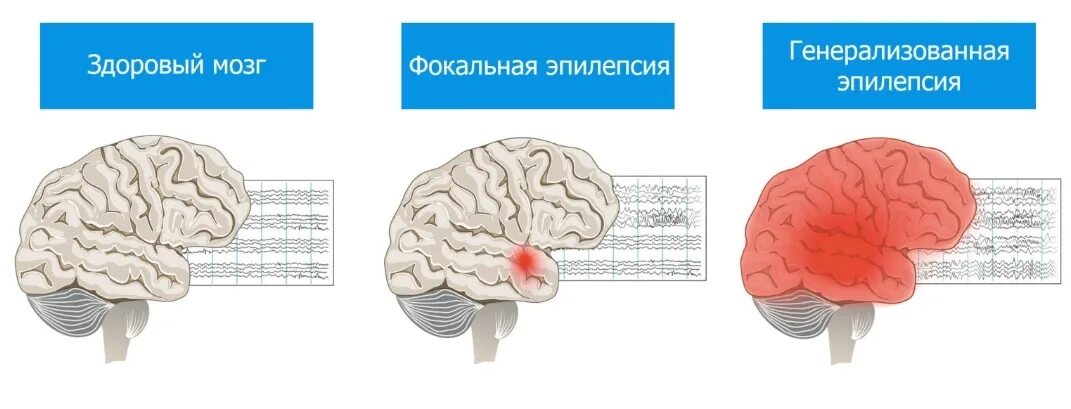 Эпилепсия симптомы кратко. Фокальный сенсорный эпилептический приступ это. Тонико-клонические судороги у детей. Структурно фокальная эпилепсия. Эпилепсия судорожные симптомы.