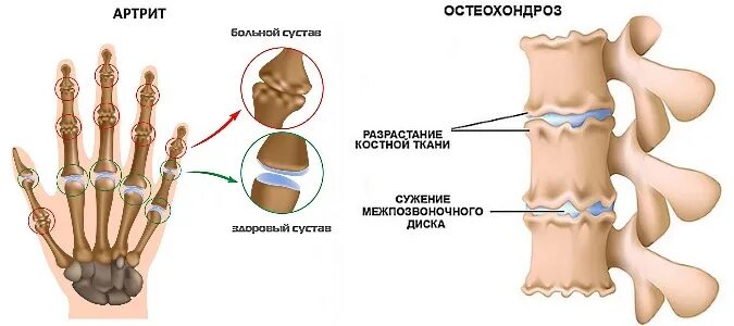 Типы артритов. Остеохондроз кости. Остеохондроз костей. Ревматоидный артрит и остеохондроз.