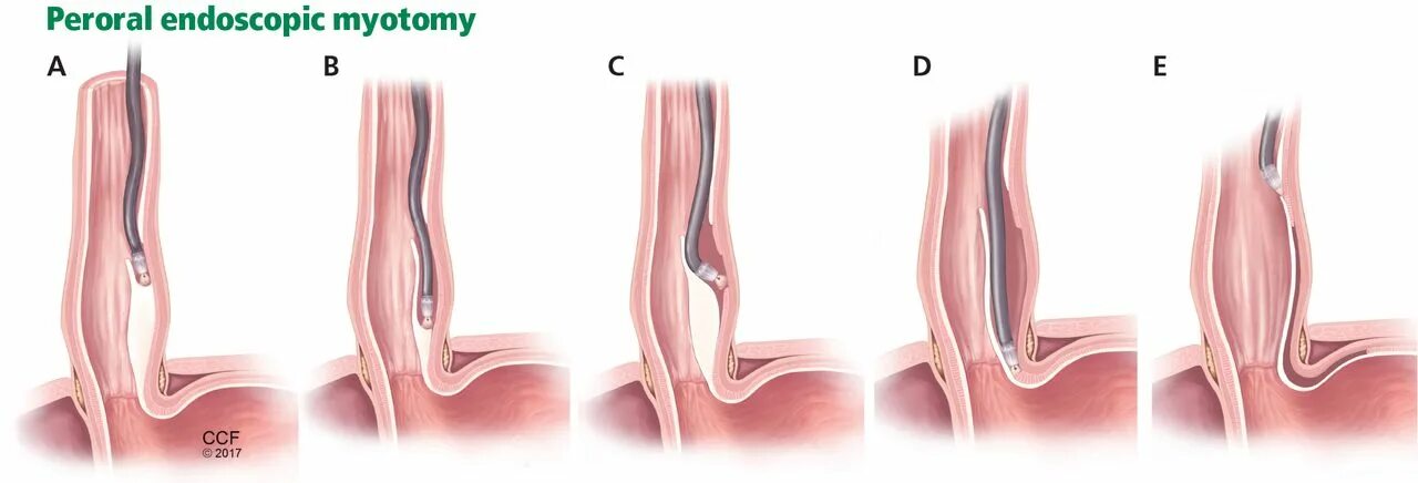 Ахалазия пищевода операция. Ахалазия кардии операция. Ахалазия кардии пищевода операция.
