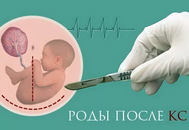 Рожу сама. Естественные роды после кесарева сечения. Роженица после КС.