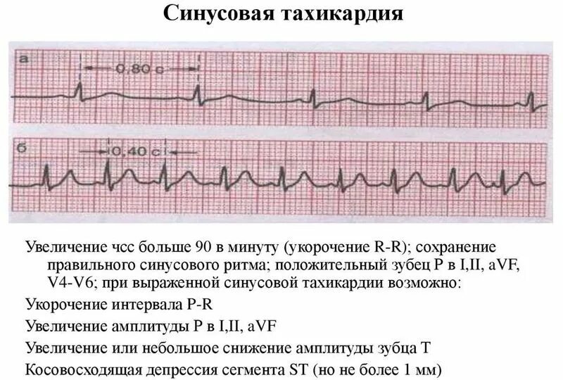 Сопровождается повышением частоты сердечных сокращений