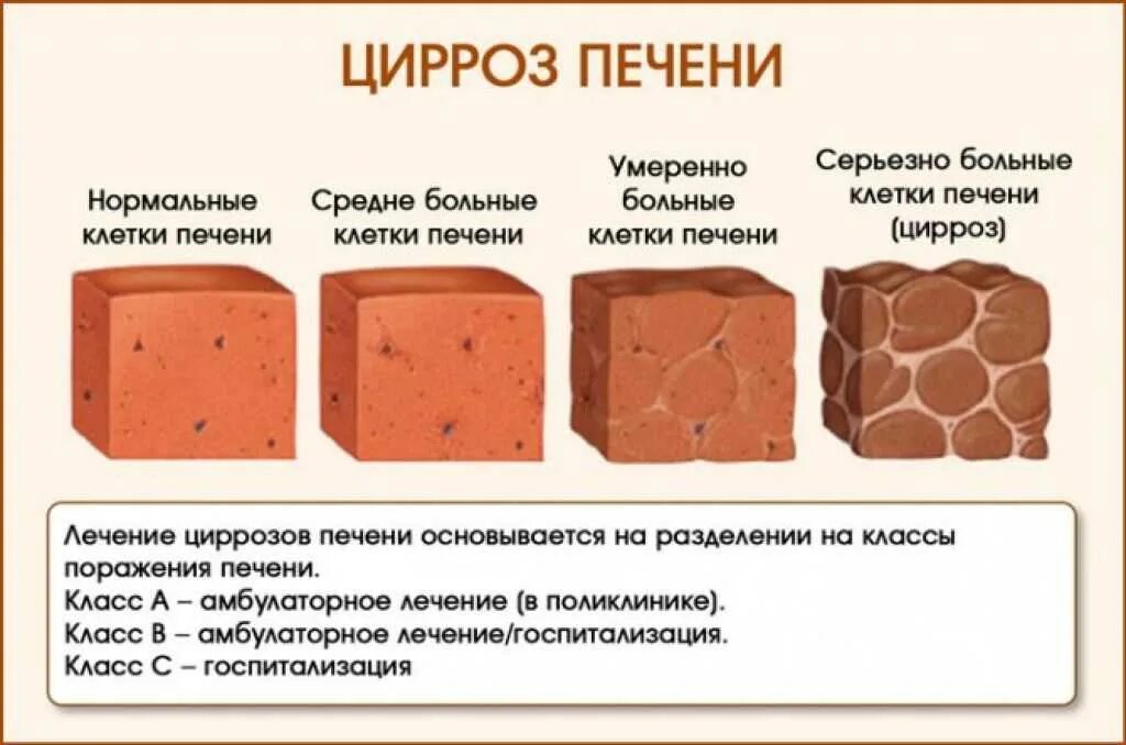 Быстрее разлагается печень песня. Симптомы первой стадии цирроза печени. Симптомы цирроз цирроз печени. Степени поражения печени.