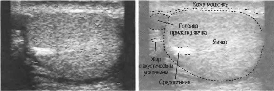 Болит яичко у мужчины. Анатомия придатка яичка на УЗИ. Головка придатка яичка на УЗИ. Привесок придатка яичка на УЗИ.