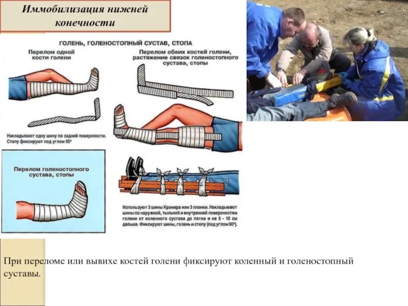 Иммобилизация костей голени алгоритм. Транспортная иммобилизация костей голени. Транспортная иммобилизация костей нижних конечностей алгоритм. 2. Транспортная иммобилизация при переломе костей голени.. Мобилизация коленного сустава