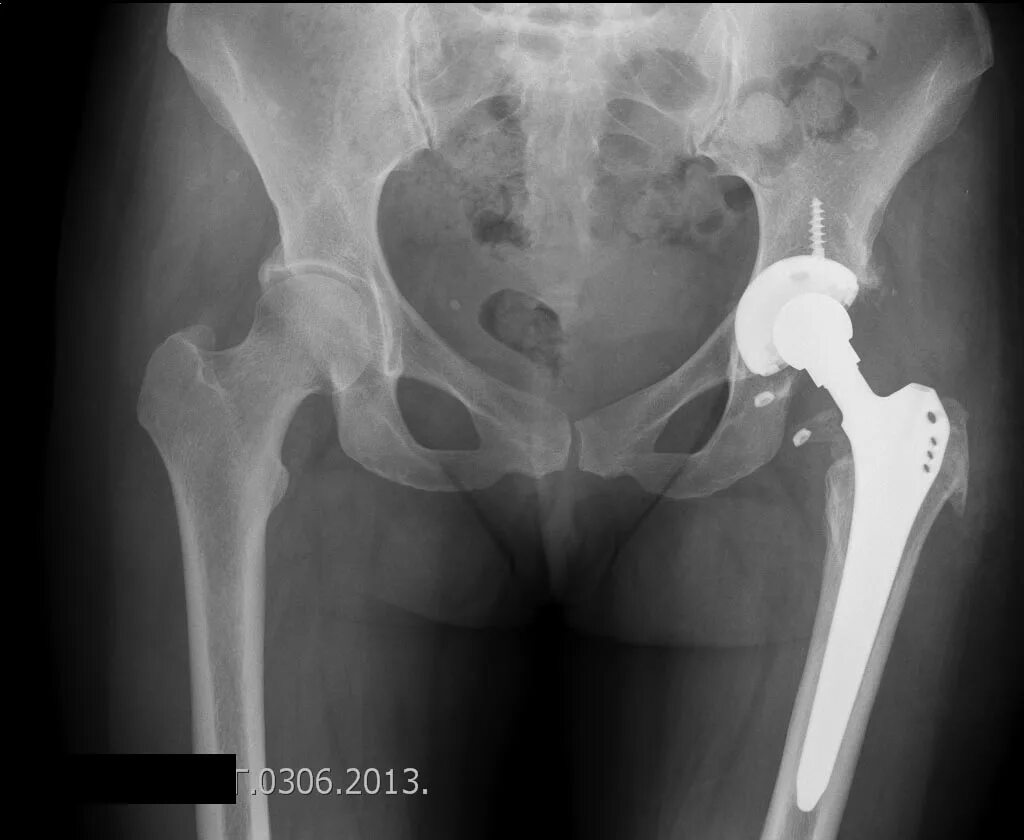 Варусный перелом шейки бедра рентген. Вывих эндопротеза мкб 10. Вывих эндопротеза тазобедренного сустава рентген. Вывих эндопротеза мкб 10. Вывих головки эндопротеза тазобедренного сустава рентген.