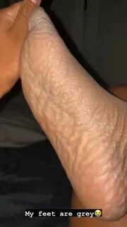 Wrinkled foot