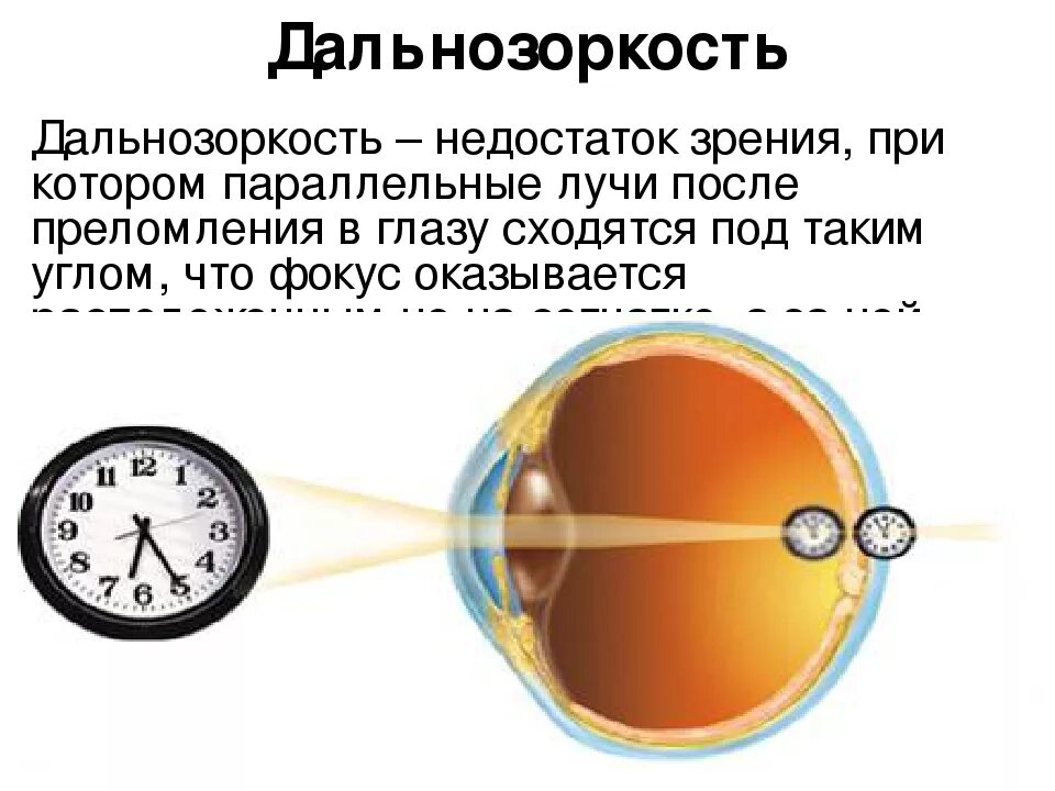 Зрение минус это близорукость или дальнозоркость. Дальнозоркость это плюс или минус. Зрение дальнозоркость плюс или минус. Дефекты зрения дальнозоркость. Близко видеть далеко плохо