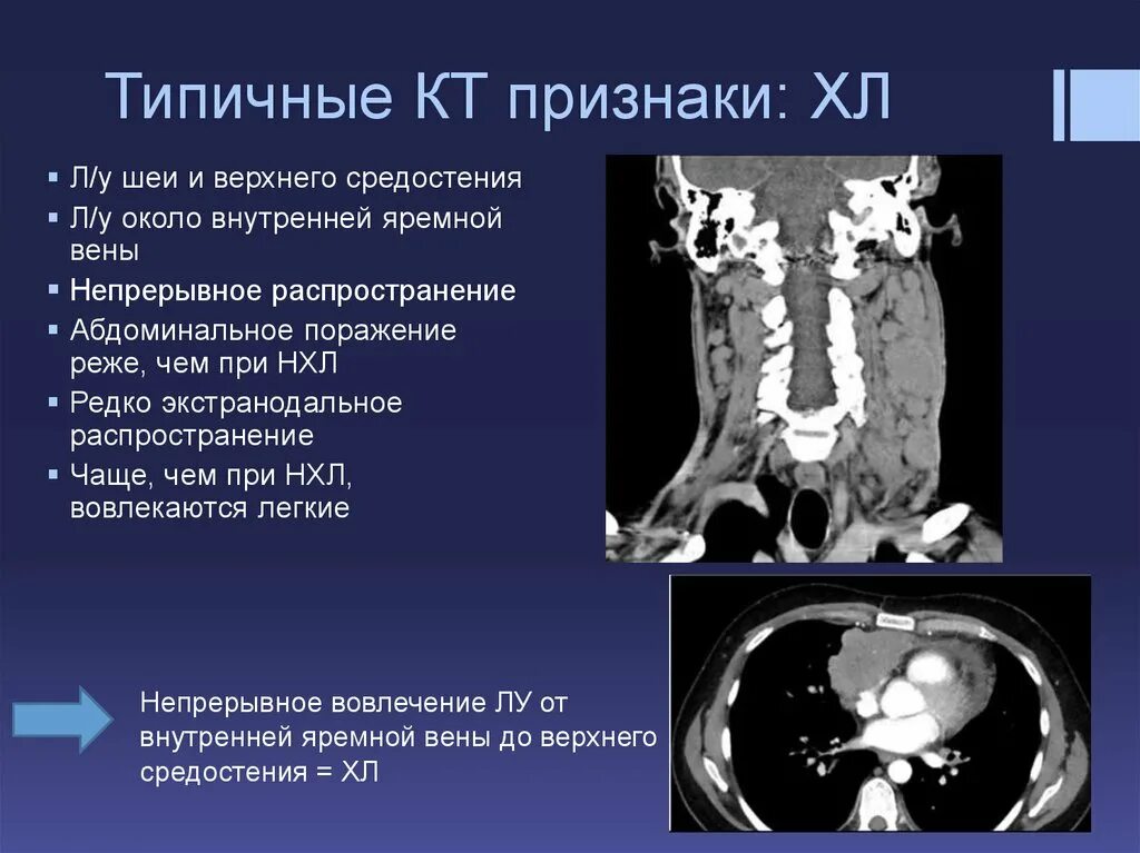 Расширение яремной вены. Внутренняя яремная Вена анатомия кт.