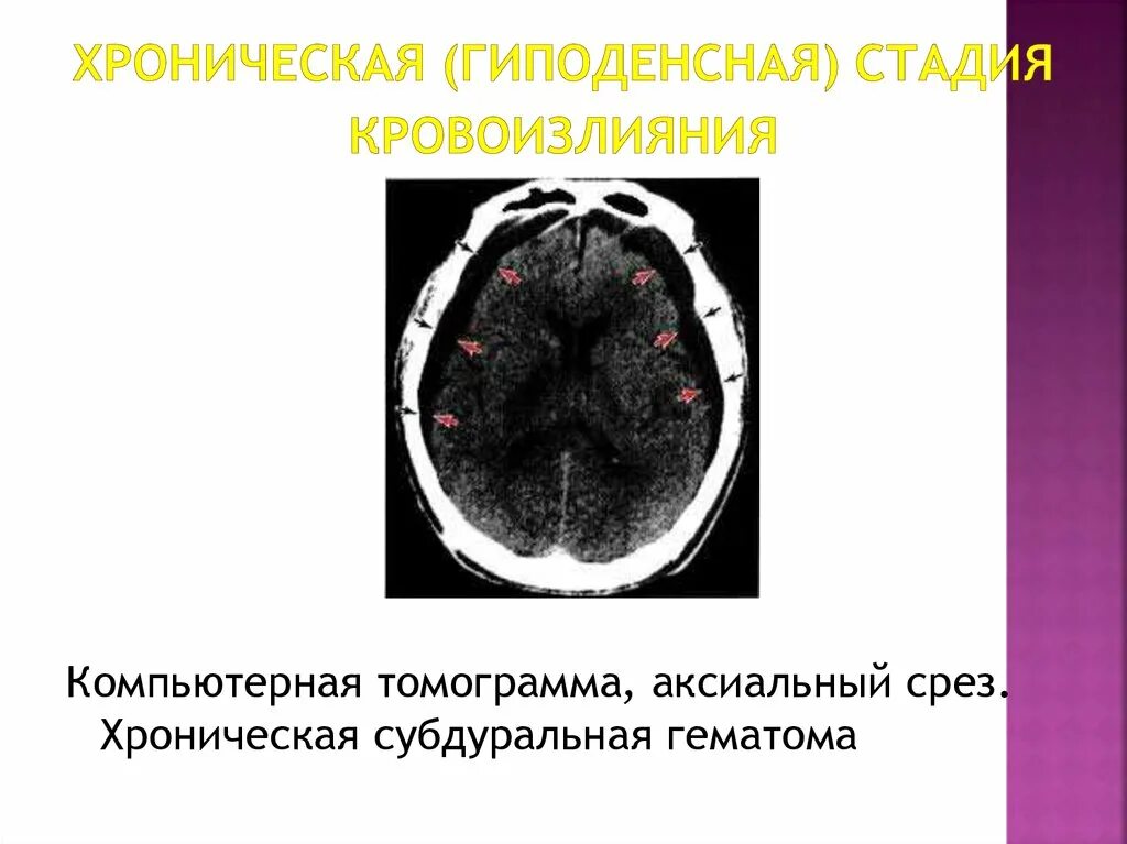 Хроническая субдуральная гематома. Субдуральная гематома головного мозга мрт. Конвекситальная субдуральная гематома. Хроническая субдуральная гематома на кт. Гематома в стадии организации