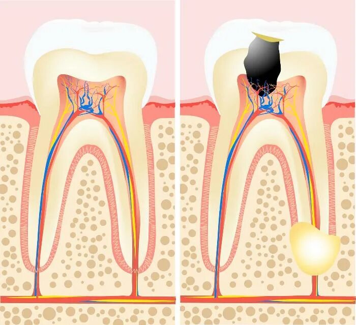 Лечение пульпита в Москве: цены от 1 500 ₽ в стоматологии BrainMark Dental Studi