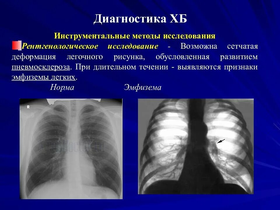 Легочной рисунок диффузно деформирован. Диффузный пневмосклероз рентген. эмфизема рентген снимки. легочный рисунок деформирован. пневмосклероз легкого рентген.