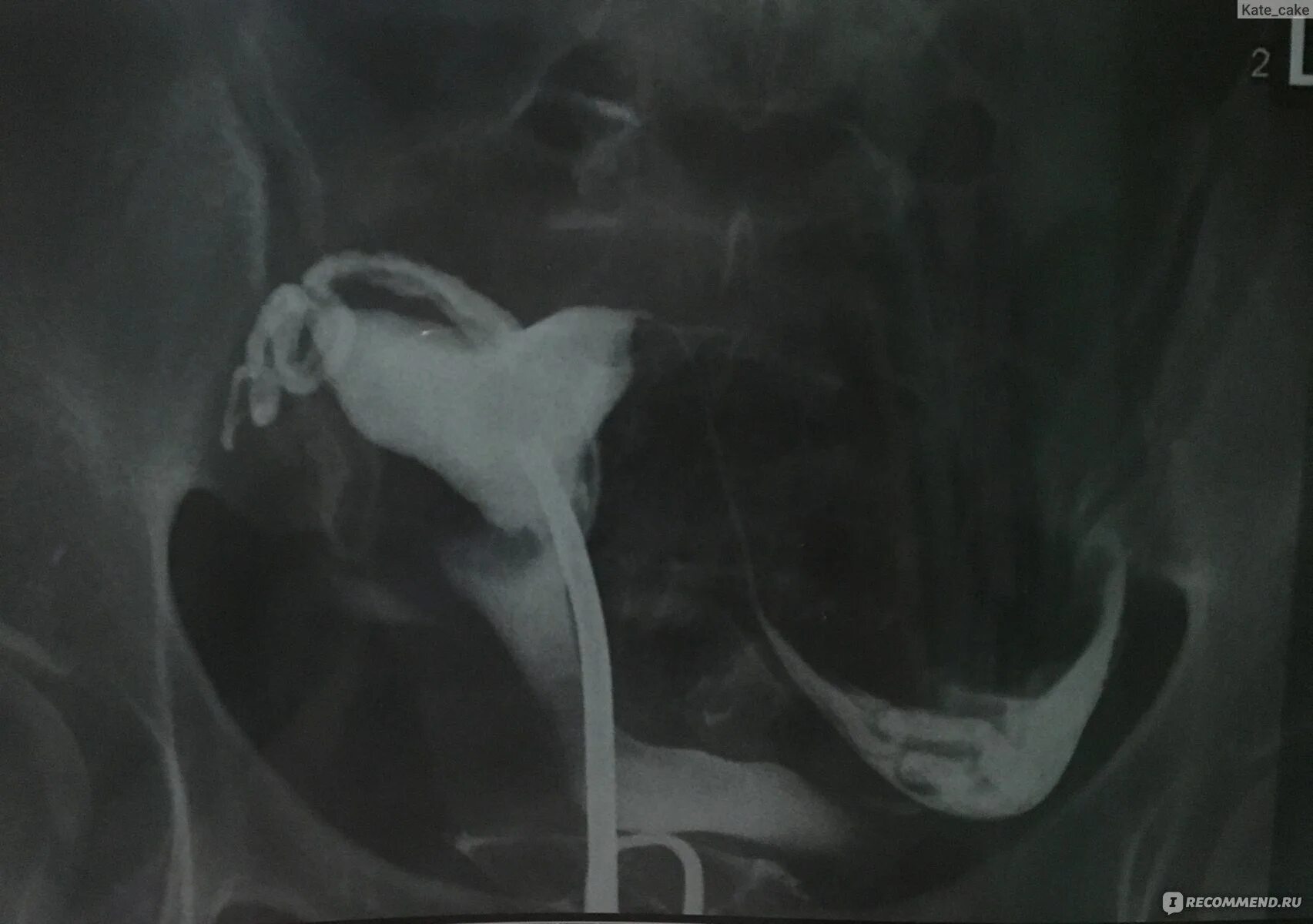 Гсг рентген маточных труб. Гсг снимок маточных труб рентген. Гсг казань. Оборудование для гистеросальпингографии. Гсг казань.