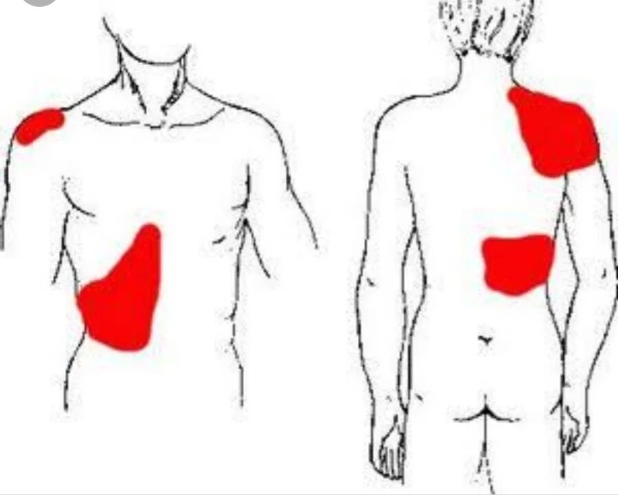 Пищевод отдает в спину. Желчная колика иррадиация боли. Печеночная колика иррадиация боли. Острый холецистит иррадиация болей.