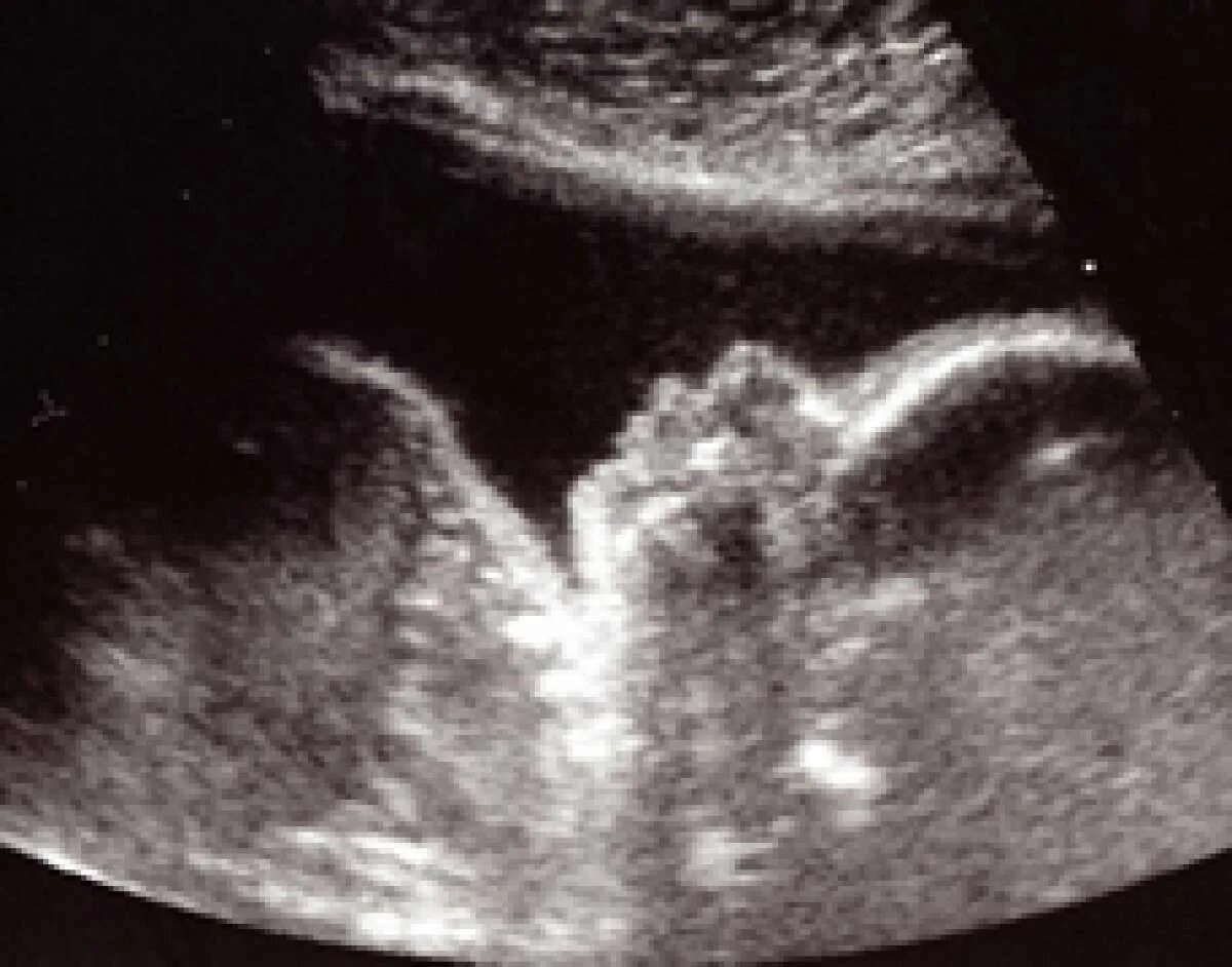 Nose of fetus on Ultrasound.