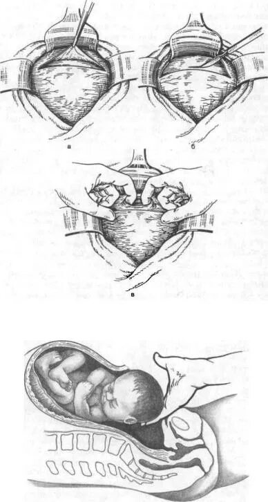 Кесарево сечение в Нижнем сегменте матки. Техника корпорального кесарева сечения. Кесарево сечение в Нижнем сегменте поперечным разрезом. Интраперитонеальное кесарево сечение. Техника кесарева сечения