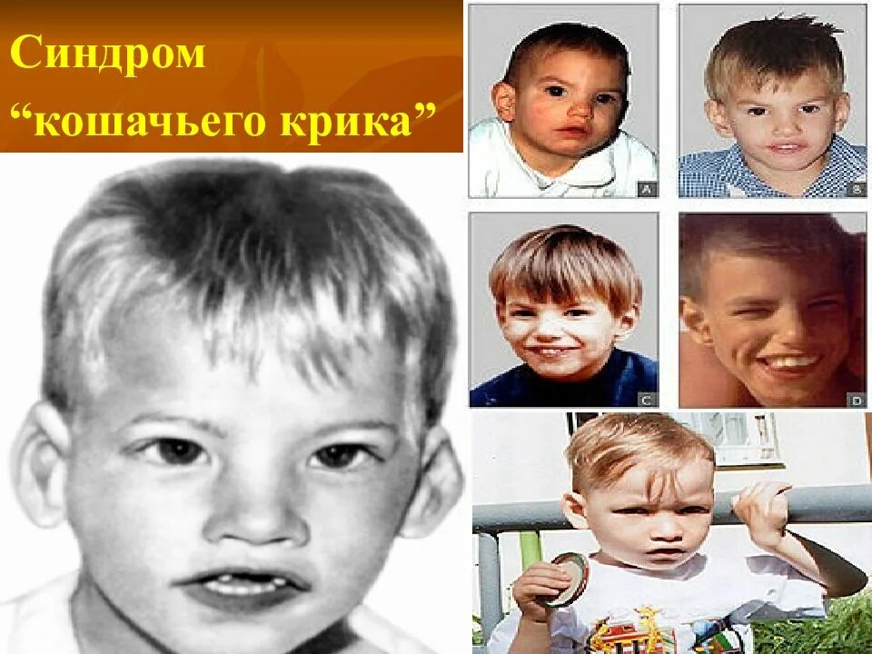 Синдром кошачьего крика симптомы. Лежена синдром кошачьего крика. идиограмма синдрома кошачьего крика. синдром кошачьего крика кардиограмма.