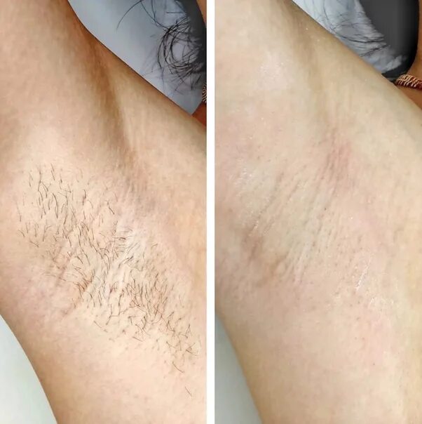 Шугаринг бикини до и после. Восковая эпиляция глубокое бикини. Шугаринг бикини. Шугаринг бикини до и после. Шугаринг бикини.