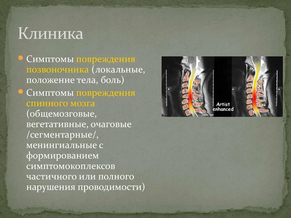 Повреждение позвоночника необходимо. Клиника повреждения спинного мозга. Травмы позвоночника клиника. Симптомы повреждения позвоночника. Травма позвоночника симптомы.