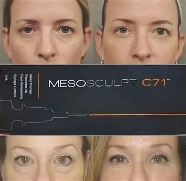 Препарат MESOEYE c71. Биоревитализация MESOEYE. Биорепарация MESOEYE c71. Биорепарация МЕЗОАЙ c71. Мезая