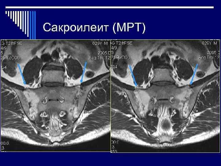 Критерии сакроилеита мрт. Мрт сакроилеальных сочленений.