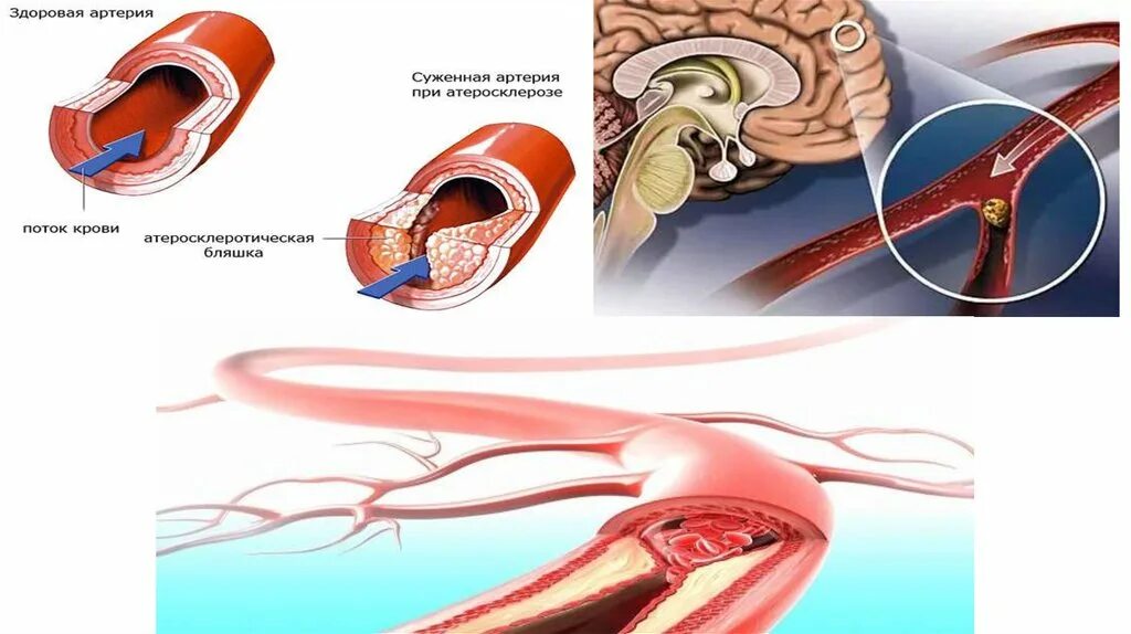 Атеросклероз артерий головного мозга. Бляшки в сосудах головного мозга. Атеросклероз сосудов мозга. Атеросклероз артерий основания мозга. Лечение церебрального атеросклероза сосудов головного