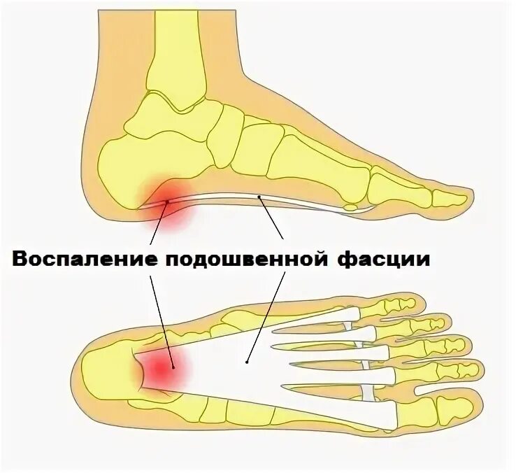 Подошвенный фасциит что это такое. Подошвенный (плантарный) фасциит. Подошвенный (плантарный) фасциит клиника. Плантарный апоневроз стопы.