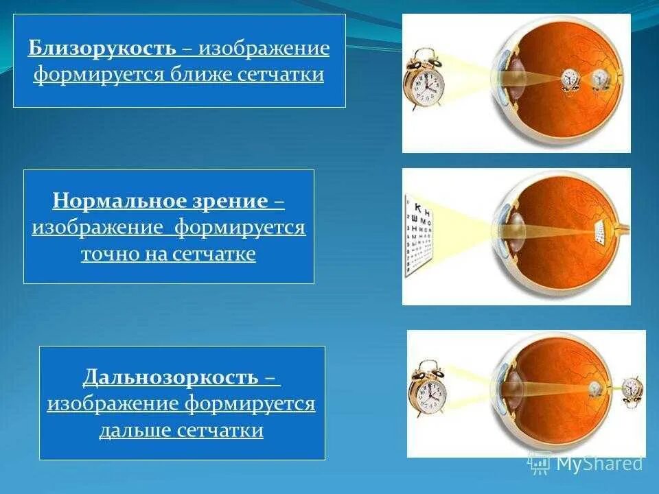 Близорукость и дальнозоркость. Близорукость сетчатка. Миопия гиперметропия астигматизм пресбиопия. Норма близорукость дальнозоркость. Близорукость причины возникновения