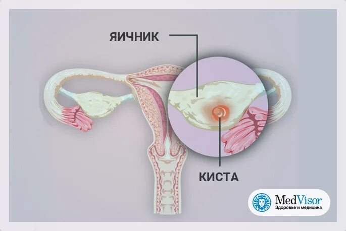 Задержка месячных при кисте яичника