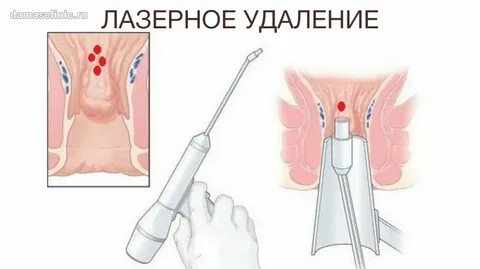 Операция геморроя сколько реабилитация