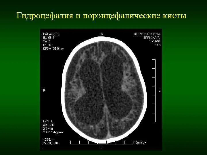 Порэнцефалическая киста. Порэнцефалическая киста бокового желудочка. Порэнцефалическая киста на кт.