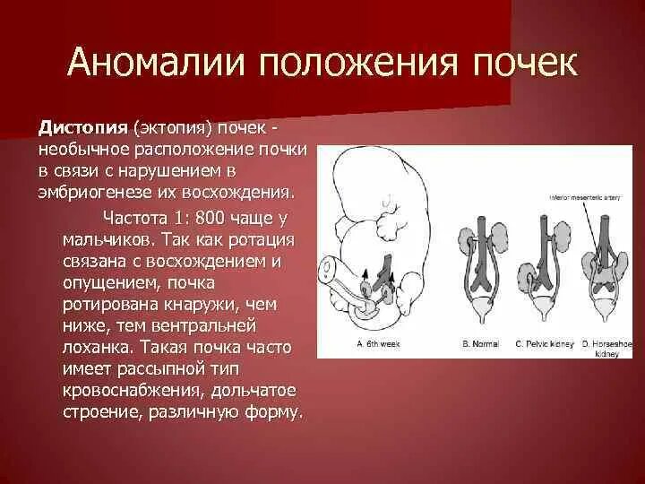 Аномалии развития мочеполовой. Врожденные пороки развития мочевыделительной системы. Аномалии положения почек. Дистопия (эктопия) почек. Аномалии расположения почек.