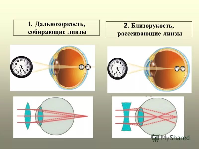 Линзы очков для близорукости