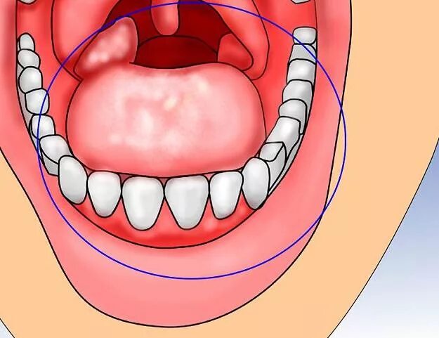 Проявление СПИДА В полости рта. Вич инфекция рту