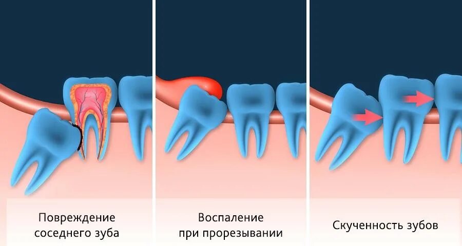 Лечение зуба 8. Неправильный рост зубов мудрости. Коренные зубы и зубы мудрости.