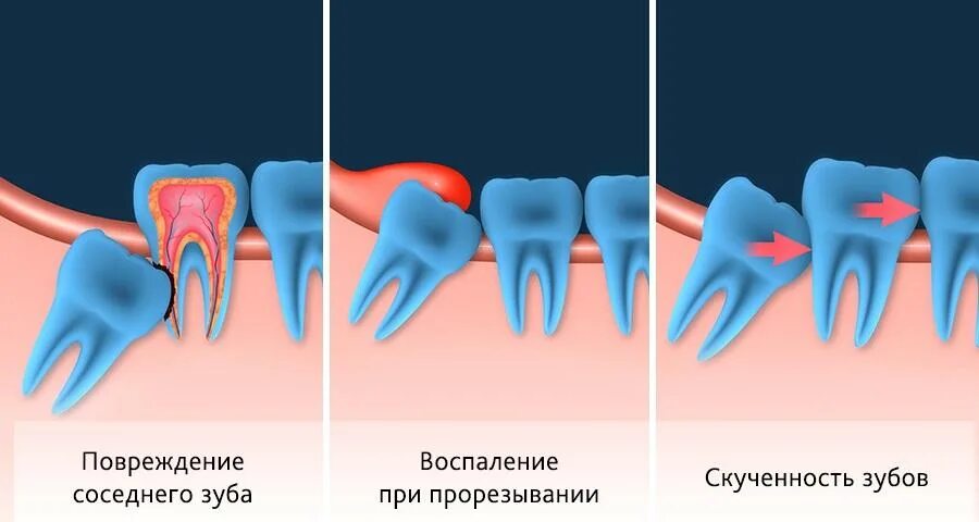 Почему зуб назвали зубом. Ретинированный дистопированный зуб. неправильное расположение зуба мудрости.