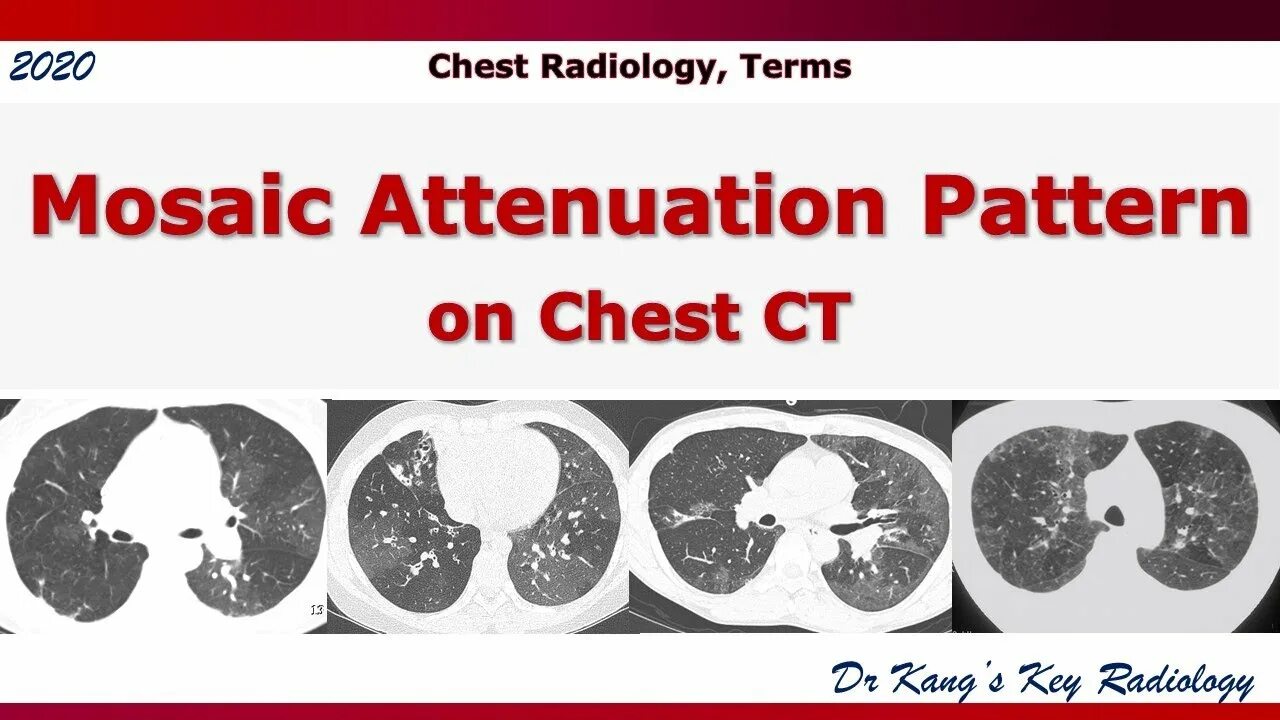 Mosaic pattern of perfusion. Chest Radiology patterns an. CT perfusion hypoperfuson Index. Ct term