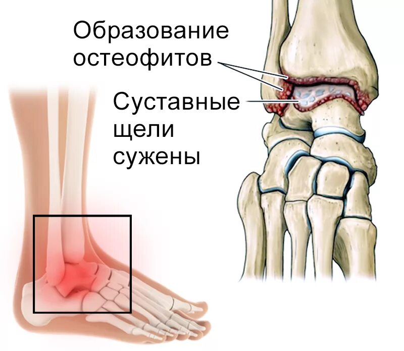 Partial Tendon Tear Doctor in San Diego Patient Success with Dr. Ambach