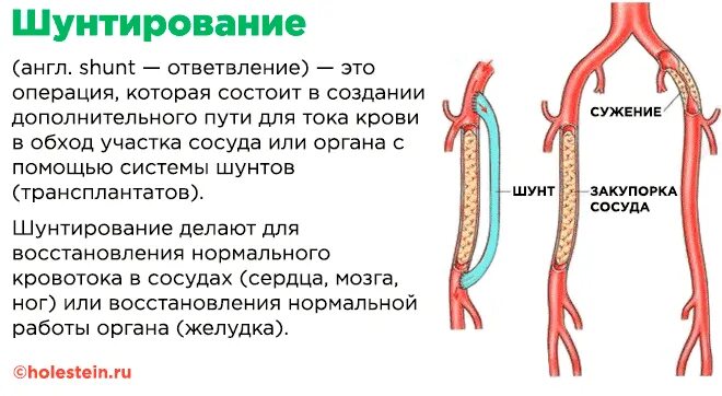 Головные шунты. Коронарное шунтирование. Операция аортокоронарного шунтирования.