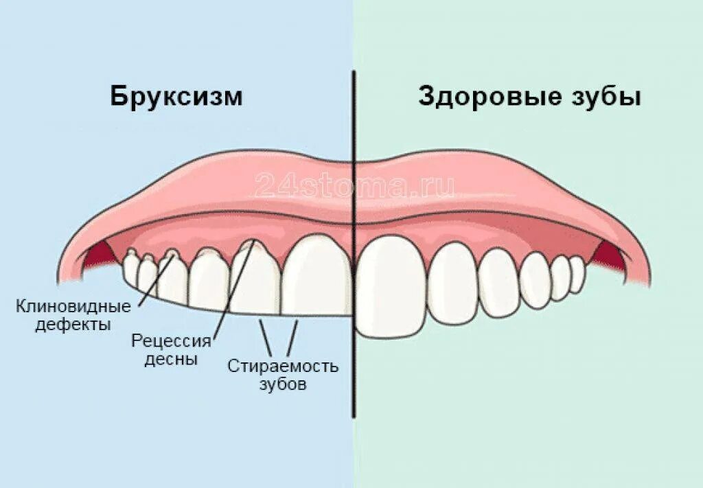 Сильно сжимаю зубы. Скрежет зубами во сне причины.