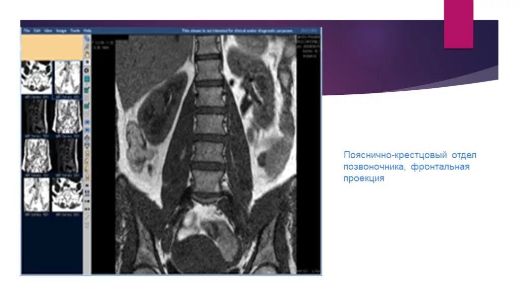 Мрт пояснично крестцового отдела позвоночника цена москва. Мрт пояснично-крестцового отдела позвоночника. Фронтальный мрт позвонок. Мрт пояснично-крестцового отдела позвоночника фронтальная проекция. Мрт поясничной области.