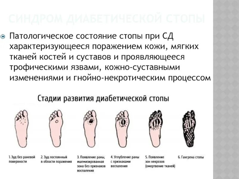 Диабетическая стопа код 10. Диабетическая стопа гангрена пальца. Синдромы при диабетической стопе. Формы синдрома диабетической стопы. Диабетическая стопа язва.