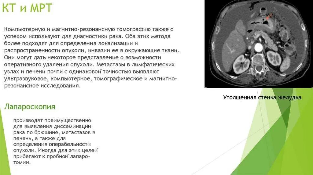 Что такое кт при онкологии