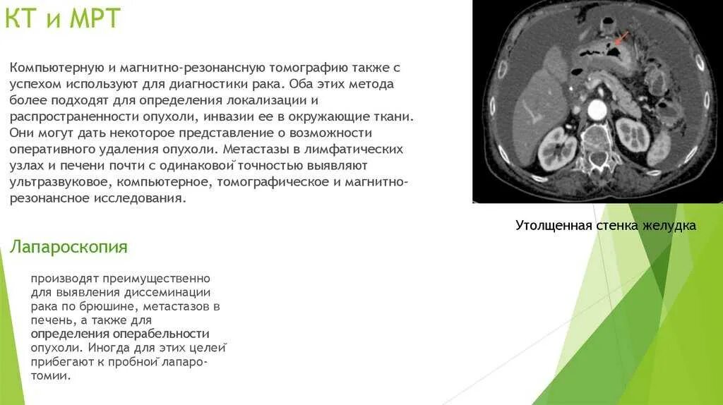 Объемные образования печени на мрт. Метастазы в печени на кт заключение. Язва кт