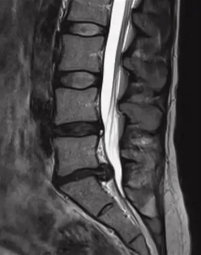 Остеохондроз поясничного отдела l5 s1. Диски l5-s1 в позвоночнике. Грыжи л5 с1 позвонков. Межпозвонковый диск l5-s1. Диск l5-s1 сегмента.