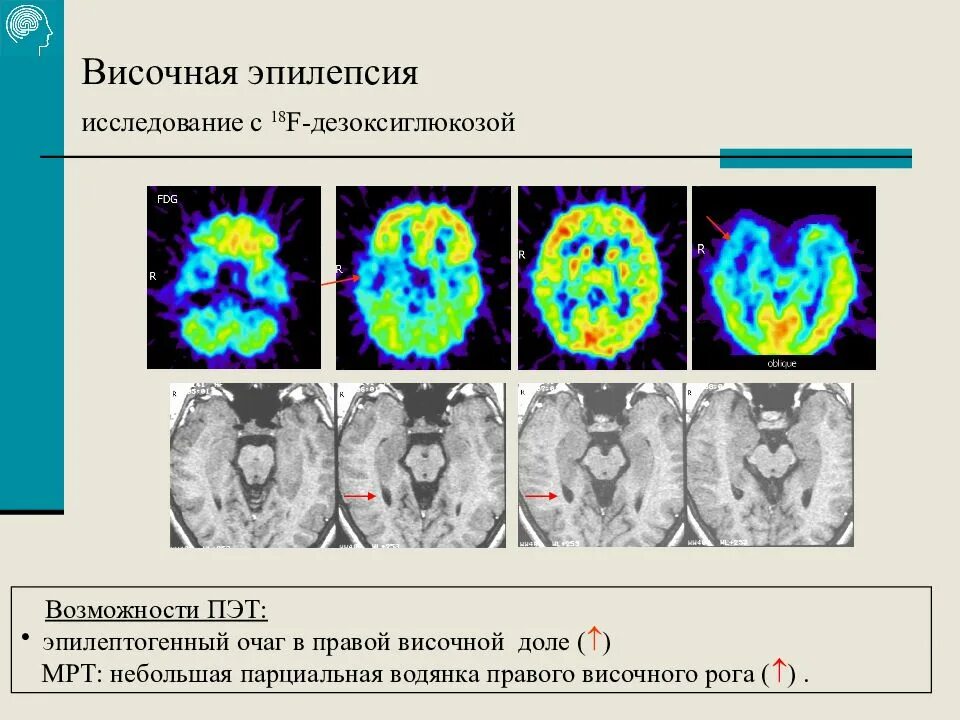 Приступы височной эпилепсии