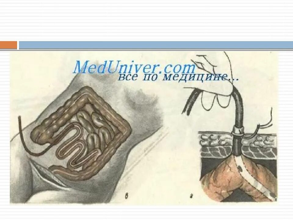 Код свища
