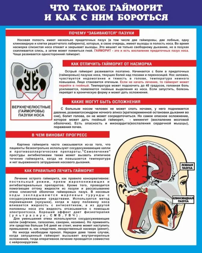 Профилактика острого гайморита. Профилактика острого синусита. Симптомы гайморита у взрослых без температуры признаки