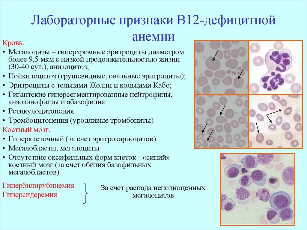 Синдром тельца. Эритроциты при в 12 анемии. Анализ крови при анемии в12 дефицитной анемии. В12 дефицитная анемия анализ крови показатели. В12 фолиеводефицитная анемия анализ.