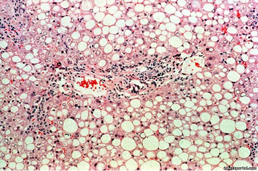Токсическая дистрофия печени. Жировая дистрофия печени микропрепарат. Жировой гепатоз печени гистология. Жировая дистрофия печени микро. Жировая дистрофия печени патанатомия.
