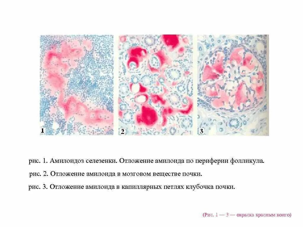 Саговая селезенка. Амилоидоз почки окраска Конго-рот. Саговая селезенка патанатомия. Амилоидоз селезенки саговая селезенка микропрепарат.